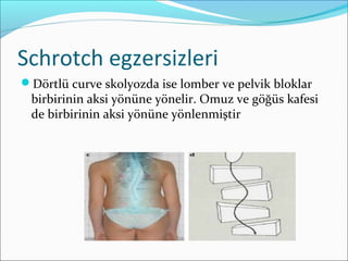 Schrotch egzersizleri
Dörtlü curve skolyozda ise lomber ve pelvik bloklar
birbirinin aksi yönüne yönelir. Omuz ve göğüs kafesi
de birbirinin aksi yönüne yönlenmiştir
 