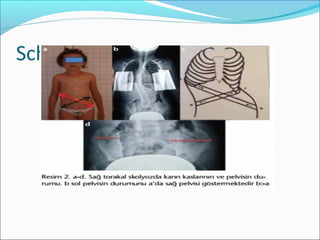 Schrotch egzersizleri
 