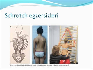 Schrotch egzersizleri
 