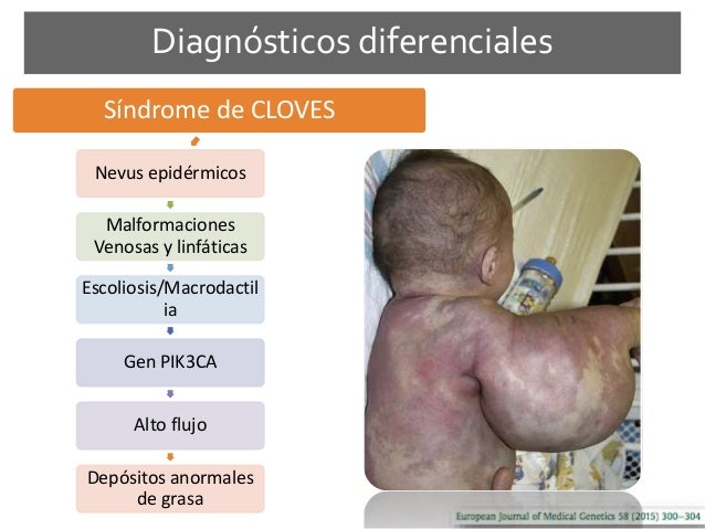 Klippel Trenaunay Syndrome