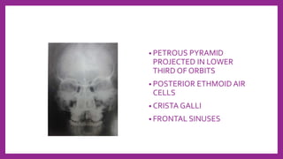 • PETROUS PYRAMID
PROJECTED IN LOWER
THIRD OF ORBITS
• POSTERIOR ETHMOID AIR
CELLS
• CRISTA GALLI
• FRONTAL SINUSES
 