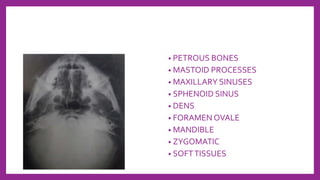 • PETROUS BONES
• MASTOID PROCESSES
• MAXILLARY SINUSES
• SPHENOID SINUS
• DENS
• FORAMEN OVALE
• MANDIBLE
• ZYGOMATIC
• SOFTTISSUES
 