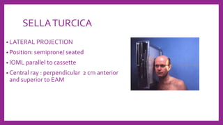 SELLATURCICA
• LATERAL PROJECTION
• Position: semiprone/ seated
• IOML parallel to cassette
• Central ray : perpendicular 2 cm anterior
and superior to EAM
 