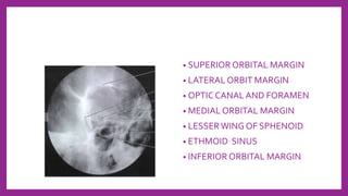 • SUPERIOR ORBITAL MARGIN
• LATERAL ORBIT MARGIN
• OPTIC CANAL AND FORAMEN
• MEDIAL ORBITAL MARGIN
• LESSERWING OF SPHENOID
• ETHMOID SINUS
• INFERIOR ORBITAL MARGIN
 