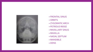 • FRONTAL SINUS
• ORBITS
• ZYGOMATIC ARCH
• PETROUS RIDGE
• MAXILLARY SINUS
• MAXILLA
• NASAL SEPTUM
• MANDIBLE
• DENS
 