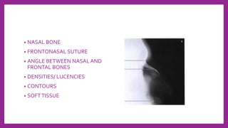 • NASAL BONE
• FRONTONASAL SUTURE
• ANGLE BETWEEN NASAL AND
FRONTAL BONES
• DENSITIES/ LUCENCIES
• CONTOURS
• SOFTTISSUE
 