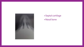 • Septal cartilage
• Nasal bone
 