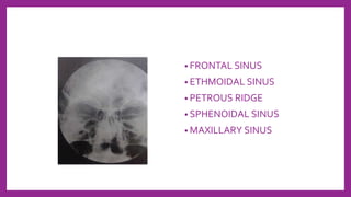 • FRONTAL SINUS
• ETHMOIDAL SINUS
• PETROUS RIDGE
• SPHENOIDAL SINUS
• MAXILLARY SINUS
 