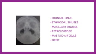 • FRONTAL SINUS
• ETHMOIDAL SINUSES
• MAXILLARY SINUSES
• PETROUS RIDGE
• MASTOID AIR CELLS
• ORBIT
 
