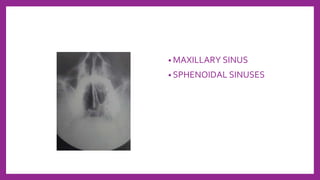 • MAXILLARY SINUS
• SPHENOIDAL SINUSES
 