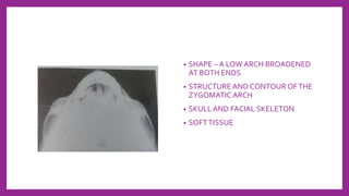 • SHAPE – A LOW ARCH BROADENED
AT BOTH ENDS
• STRUCTURE AND CONTOUR OFTHE
ZYGOMATIC ARCH
• SKULL AND FACIAL SKELETON
• SOFTTISSUE
 