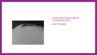 • SHAPE AND STRUCTURE OF
ZYGOMATIC ARCH
• SOFTTISSUES
 