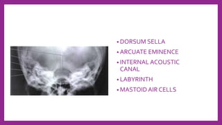 • DORSUM SELLA
• ARCUATE EMINENCE
• INTERNAL ACOUSTIC
CANAL
• LABYRINTH
• MASTOID AIR CELLS
 