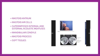 • MASTOID ANTRUM
• MASTOID AIR CELLS
• SUPERIMPOSED INTERNAL AND
EXTERNAL ACOUSTIC MEATUSES
• MANDIBULAR CONDYLE
• MASTOID PROCESS
• SOFTTISSUES
 