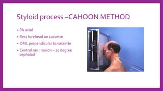 Styloid process –CAHOON METHOD
• PA axial
• Rest forehead on cassette
• OML perpendicular to cassette
• Central ray : nasion – 25 degree
cephalad
 