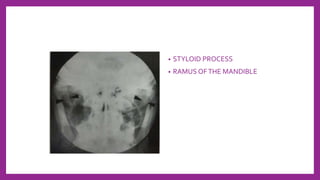 • STYLOID PROCESS
• RAMUS OFTHE MANDIBLE
 