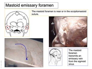 Mastoid emissary foramen The mastoid foramen is near or in the occipitomastoid suture. The mastoid foramen transmits an emissary vein from the sigmoid sinus 