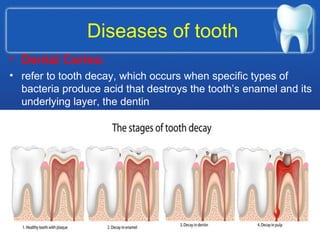 Diseases of tooth
• Dental Caries:
• refer to tooth decay, which occurs when specific types of
bacteria produce acid that destroys the tooth’s enamel and its
underlying layer, the dentin
 