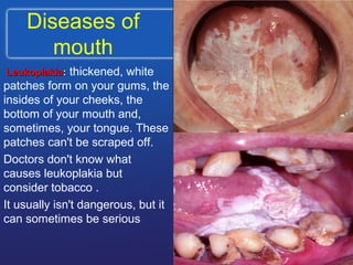 Diseases of
mouth
LeukoplakiaLeukoplakia:: thickened, white
patches form on your gums, the
insides of your cheeks, the
bottom of your mouth and,
sometimes, your tongue. These
patches can't be scraped off.
Doctors don't know what
causes leukoplakia but
consider tobacco .
It usually isn't dangerous, but it
can sometimes be serious
 