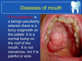 Diseases of mouth
• Torus palatinus is
a benign peculiarity
wherein there is a
bony outgrowth on
the palate. It is a
normal bump on
the roof of the
mouth. It is not
cancerous, nor it is
painful or sore.
 