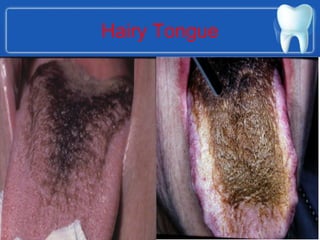 Hairy Tongue
 
