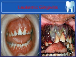 Leukemic Gingivitis
 