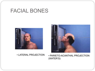 FACIAL BONES
• LATERAL PROJECTION • PARIETO-ACANTHAL PROJECTION
(WATER’S)
 
