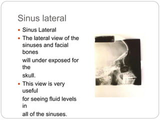 Sinus lateral
 Sinus Lateral
 The lateral view of the
sinuses and facial
bones
will under exposed for
the
skull.
 This view is very
useful
for seeing fluid levels
in
all of the sinuses.
 