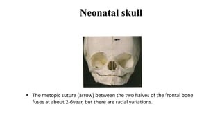 Neonatal skull
• The metopic suture (arrow) between the two halves of the frontal bone
fuses at about 2-6year, but there are racial variations.
 
