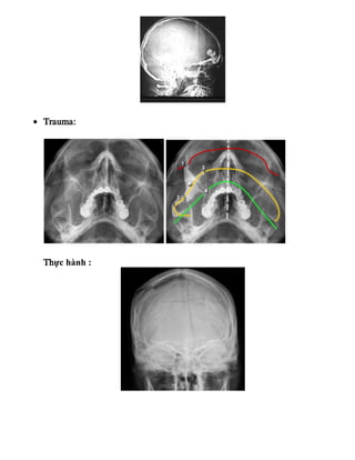 • Trauma:
Thực hành :
 