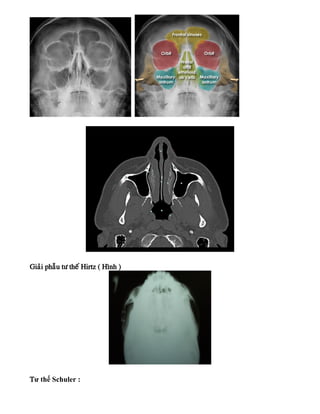 Giaûi phaãu tö theá Hirtz ( Hình )
Tư thế Schuler :
 