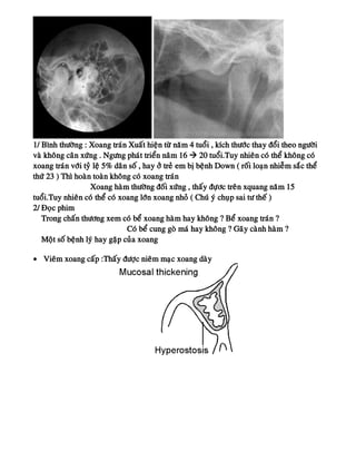 1/ Bình thöôøng : Xoang traùn Xuaát hieän töø naêm 4 tuoåi , kích thöôùc thay ñoåi theo ngöôøi
vaø khoâng caân xöùng . Ngöng phaùt trieån naâm 16  20 tuoåi.Tuy nhieân coù theå khoâng coù
xoang traùn vôùi tyû leä 5% daân soá , hay ôû treû em bò beänh Down ( roái loaïn nhieãm saéc theå
thöù 23 ) Thì hoaøn toaøn khoâng coù xoang traùn
Xoang haøm thöôøng ñoái xöùng , thaáy ñöïôc treân xquang naêm 15
tuoåi.Tuy nhieân coù theå coù xoang lôùn xoang nhoû ( Chuù yù chuïp sai tö theá )
2/ Ñoïc phim
Trong chaán thöông xem coù beå xoang haøm hay khoâng ? Beå xoang traùn ?
Coù beå cung goø maù hay khoâng ? Gaõy caønh haøm ?
Moät soá beänh lyù hay gaëp cuûa xoang
• Vieâm xoang caáp :Thaáy ñöôïc nieâm maïc xoang daøy
 