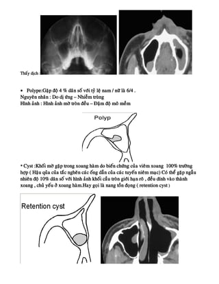 Thaáy dòch :
• Polype:Gaëp ñoä 4 % daân soá vôùi tyû leä nam / nöõ laø 6/4 .
Nguyeân nhaân : Do dò öùng – Nhieãm truøng
Hình aûnh : Hình aûnh môø troøn ñeàu – Ñaäm ñoä moâ meàm
* Cyst :Khoái môø gaëp trong xoang haøm do bieán chöùng cuûa vieâm xoang 100% tröôøng
hôïp ( Haäu quûa cuûa taéc ngheõn caùc oáng daãn cuûa caùc tuyeán nieâm maïc) Coù theå gaëp ngaãu
nhieân ñoä 10% daân soá vôùi hình aûnh khoái caàu troøn giôùi haïn roõ , ñeàu dính vaøo thaønh
xoang , chuû yeáu ôû xoang haøm.Hay goïi laø nang toàn ñoïng ( retention cyst )
 