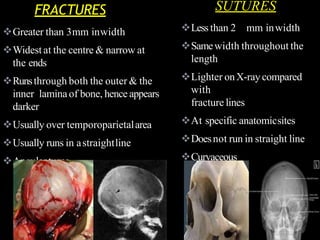 FRACTURES SUTURES
Less than 2 mm inwidth
Samewidth throughout the
length
Lighter onX-ray compared
with
fracture lines
At specific anatomicsites
Doesnot run in straight line
Curvaceous
Greater than 3mm inwidth
Widest at the centre & narrow at
the ends
Runsthrough both the outer & the
inner lamina of bone, hence appears
darker
Usually over temporoparietalarea
Usually runs in astraightline
Angularturns
 