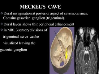 .
Dural invagination at posterior aspect of cavernous sinus.
Contains gasserian ganglion (trigeminal).
Dural layers shows thinperipheral enhancement
In MRI, 3sensorydivisions of
trigeminal nerve can be
visualized leaving the
gasserianganglion
MECKEL’S CAVE
 