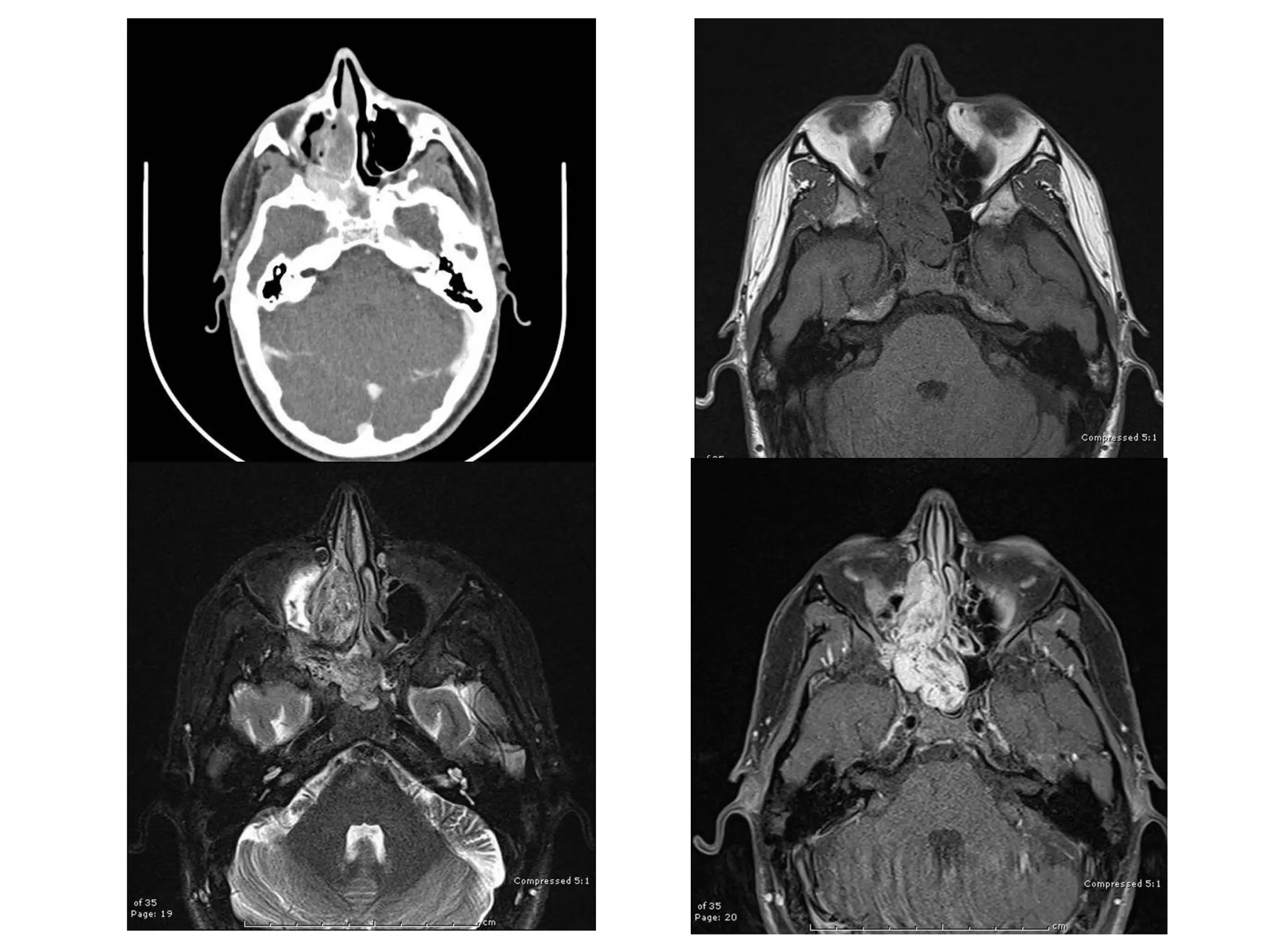 Diagnostic imaging approach in skull base lesions | PPTX