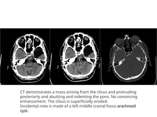 Diagnostic imaging approach in skull base lesions | PPTX