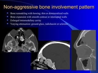 Non-aggressive bone involvement patternNon-aggressive bone involvement pattern
 Bone remodeling with bowing, thin or demineralized walls
 Bone expansion with smooth contour or interrupted walls
 Enlarged intramedullary cavity
 Varying attenuation: ground-glass, radiolucent or sclerotic
 