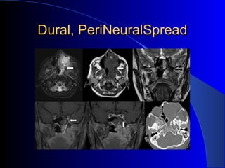 Dural, PeriNeuralSpreadDural, PeriNeuralSpread
 