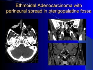 Ethmoidal Adenocarcinoma withEthmoidal Adenocarcinoma with
perineural spread in pterigopalatine fossaperineural spread in pterigopalatine fossa
 