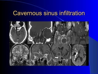 Cavernous sinus infiltrationCavernous sinus infiltration
 