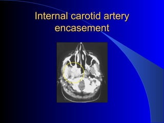 Internal carotid arteryInternal carotid artery
encasementencasement
 