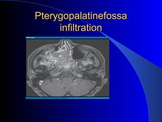 PterygopalatinefossaPterygopalatinefossa
infiltrationinfiltration
 