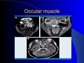 Occular muscleOccular muscle
 