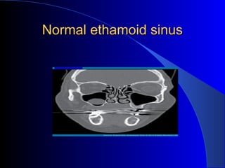 Normal ethamoid sinusNormal ethamoid sinus
 