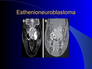 EsthenioneuroblastomaEsthenioneuroblastoma
 