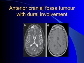 Anterior cranial fossa tumourAnterior cranial fossa tumour
with dural involvementwith dural involvement
 