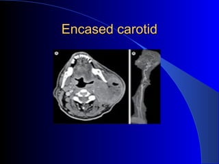 Encased carotidEncased carotid
 