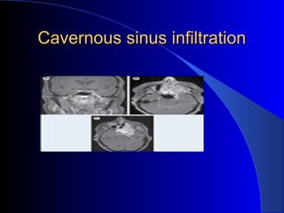 Cavernous sinus infiltrationCavernous sinus infiltration
 
