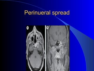 Perinueral spreadPerinueral spread
 